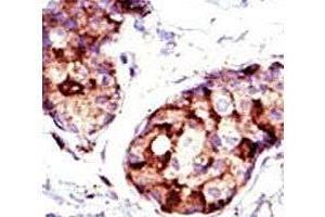 IHC analysis of FFPE human breast carcinoma tissue stained with the TSG101 antibody. (TSG101 抗体  (AA 1-30))