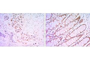 Immunohistochemical analysis of paraffin-embedded lung cancer tissues (left) and human rectum tissues (right) using KLF4 mouse mAb with DAB staining.