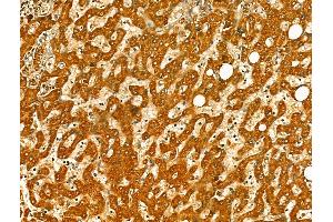 ABIN7094414 and ABIN7098461 at 1/100 staining Human pancreatic cancer by IHC-P. (OGDHL 抗体  (Internal Region))