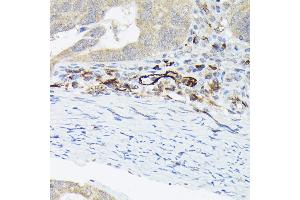 Immunohistochemistry of paraffin-embedded human colon carcinoma using von Willebrand factor (VWF) Rabbit pAb (ABIN3015449, ABIN3015450, ABIN5663874 and ABIN6217310) at dilution of 1:50 (40x lens). (VWF 抗体  (AA 50-150))