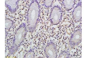 Formalin-fixed and paraffin embedded human gastric carcinoma labeled with Anti-FBP1 Polyclonal Antibody, Unconjugated (ABIN752053) at 1:200 followed by conjugation to the secondary antibody (FBP1 抗体  (AA 31-130))