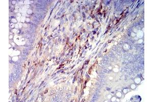 Immunohistochemical analysis of paraffin-embedded rectum cancer tissues using CD61 mouse mAb with DAB staining. (Integrin beta 3 抗体  (AA 27-179))