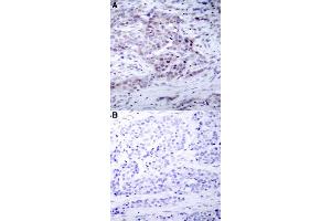 Immunohistochemical staining of human breast cancer tissue with NFKB2 (phospho S870) polyclonal antibody  without blocking peptide (A) or preincubated with blocking peptide (B) under 1:50-1:100 dilution. (NFKB2 抗体  (pSer870))