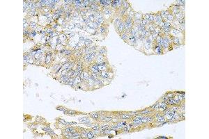 Immunohistochemistry of paraffin-embedded Human colon carcinoma using HDAC3 Polyclonal Antibody at dilution of 1:100 (40x lens). (HDAC3 抗体)