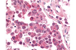 Anti-CDK12 / CRKRS antibody IHC of human Lung, Non-Small Cell Carcinoma. (CDK12 抗体  (Internal Region))