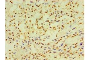 Immunohistochemistry of paraffin-embedded human breast cancer using ABIN7149254 at dilution of 1:100 (CYP2J2 抗体  (AA 328-502))