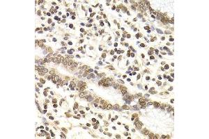 Immunohistochemistry of paraffin-embedded human gastric cancer using LMNB2 Antibody. (Lamin B2 抗体  (AA 341-620))