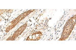 Immunohistochemistry of paraffin-embedded Human esophagus cancer tissue using DCAF10 Polyclonal Antibody at dilution of 1:130(x200) (DCAF10 抗体)