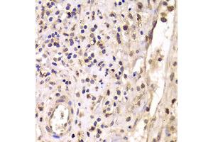 Immunohistochemistry of paraffin-embedded Human mammary cancer using HDAC4 antibody at dilution of 1:100 (x40 lens). (HDAC4 抗体)