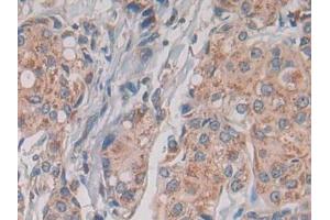 IHC-P analysis of Human Breast cancer Tissue, with DAB staining. (TLR1 抗体  (AA 114-339))