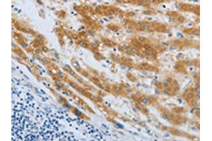 The image on the left is immunohistochemistry of paraffin-embedded Human liver cancer tissue using ABIN7190248(CHRFAM7A Antibody) at dilution 1/40, on the right is treated with synthetic peptide. (CHRNA7 抗体)