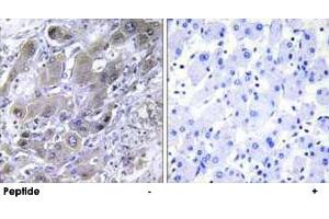 Immunohistochemistry analysis of paraffin-embedded human liver carcinoma tissue using MRPS18A polyclonal antibody . (MRPS18A 抗体)
