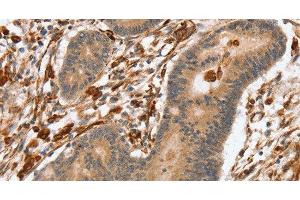 Immunohistochemistry of paraffin-embedded Human colon cancer using SSX2IP Polyclonal Antibody at dilution of 1:45 (SSX2IP 抗体)