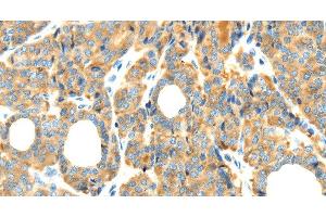 Immunohistochemistry of paraffin-embedded Human thyroid cancer tissue using RIPK4 Polyclonal Antibody at dilution 1:40 (RIPK4 抗体)