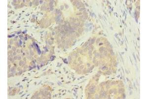 Immunohistochemistry of paraffin-embedded human gastric cancer using ABIN7165819 at dilution of 1:100 (MSTO1 抗体  (AA 1-280))