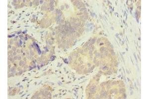 Immunohistochemistry of paraffin-embedded human gastric cancer using ABIN7165819 at dilution of 1:100