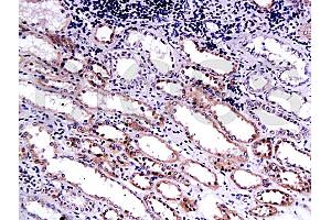 Formalin-fixed and paraffin embedded human kidney carcinoma labeled with Anti-Endostatin Polyclonal Antibody (ABIN669951), Unconjugated at 1:200, followed by conjugation to the secondary antibody and DAB staining (COL18A1 抗体  (AA 1581-1680))