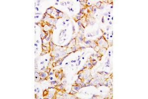 Anti-beta Catenin antibody, IHC(P) IHC(P): Human Mammary Cancer Tissue (CTNNB1 抗体  (C-Term))