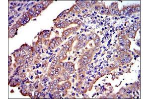Immunohistochemical analysis of paraffin-embedded intima cancer tissues using CRK mouse mAb with DAB staining. (Crk 抗体)