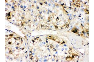 Anti- AHSG Picoband antibody, IHC(P) IHC(P): Human Liver Cancer Tissue (Fetuin A 抗体  (N-Term))