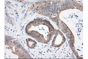 Immunohistochemical staining of paraffin-embedded Human thyroid tissue using anti-USP5 mouse monoclonal antibody. (USP5 抗体)