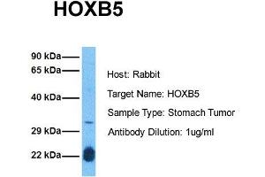 Host: Rabbit Target Name: HOXB5 Sample Tissue: Human Stomach Tumor Antibody Dilution: 1. (HOXB5 抗体  (N-Term))