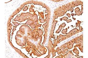 Formalin-fixed, paraffin-embedded human Breast Carcinoma stained with MUC-1 / EMA Mouse Monoclonal Antibody (MUC1/520) (MUC1 抗体)