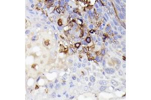 Immunohistochemistry of paraffin-embedded Human esophageal cancer using /IB antibody (527) at dilution of 1:50 (40x lens). (Iba1 抗体  (AA 1-147))