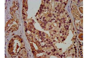 IHC image of ABIN7152156 diluted at 1:400 and staining in paraffin-embedded human prostate cancer performed on a Leica BondTM system. (EIF3G 抗体  (AA 2-320))