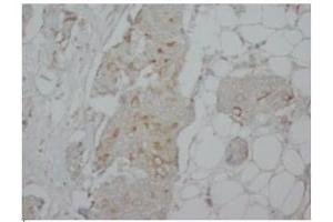 Immunohistochemical FLIPL antibody staining of Human Mammary Cancer Paraffin Sections. (FLIP 抗体  (C-Term, long form))