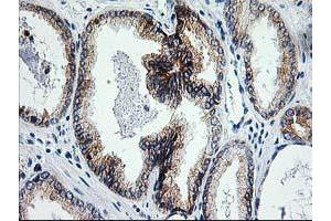Immunohistochemical staining of paraffin-embedded Carcinoma of Human prostate tissue using anti-ERCC4 mouse monoclonal antibody. (ERCC4 抗体)