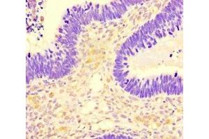 Immunohistochemistry of paraffin-embedded human ovarian cancer using ABIN7169732 at dilution of 1:100 (SMCO1 抗体  (AA 82-214))