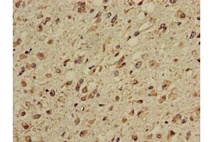 Immunohistochemistry of paraffin-embedded human glioma using ABIN7146829 at dilution of 1:100 (CPT1C 抗体  (AA 699-803))