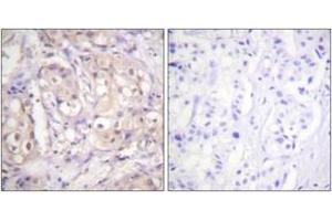 Immunohistochemistry analysis of paraffin-embedded human breast carcinoma, using B-RAF (Phospho-Thr599) Antibody. (SNRPE 抗体  (pThr599))