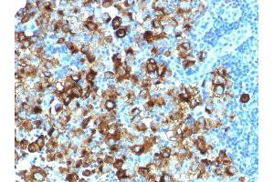 Formalin-fixed, paraffin-embedded human Melanoma stained with gp100 Rabbit Recombinant Monoclonal Antibody (PMEL/1825R). (Recombinant Melanoma gp100 抗体)