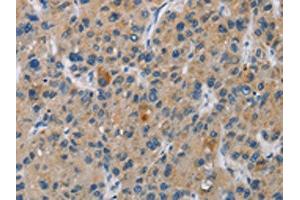 The image is immunohistochemistry of paraffin-embedded Human liver cancer tissue using ABIN7130969(SAR1B Antibody) at dilution 1/20. (SAR1B 抗体)