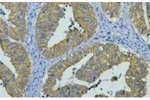 Immunohistochemistry of paraffin-embedded Human colon cancer tissue using CK-8 Monoclonal Antibody at dilution of 1:200.