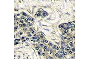 IHC analysis of FFPE human breast carcinoma stained with PI3KCA antibody (PIK3CA 抗体  (AA 504-533))