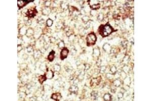 IHC analysis of FFPE human hepatocarcinoma tissue stained with the FGFR4 antibody (FGFR4 抗体  (AA 24-55))