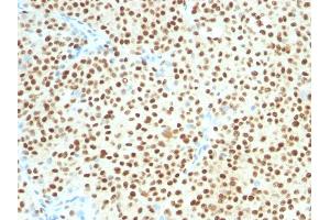 Formalin-fixed, paraffin-embedded human Melanoma stained with SOX10 Mouse Monoclonal Antibody (SOX10/1074). (SOX10 抗体  (AA 115-269))