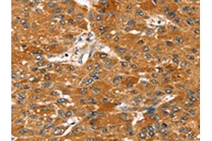 The image on the left is immunohistochemistry of paraffin-embedded Human liver cancer tissue using ABIN7131212(STARD8 Antibody) at dilution 1/20, on the right is treated with fusion protein. (STARD8 抗体)
