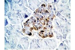 Human pancreas cancer tissue was stained by Rabbit Anti-GLP-1(7-36) -NH2 Antibody (GLP-1 抗体  (amidated))