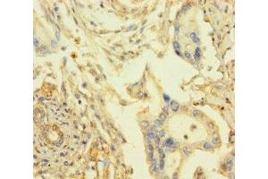 Immunohistochemistry of paraffin-embedded human pancreatic cancer using ABIN7167948 at dilution of 1:100 (ARHGAP27 抗体  (AA 1-300))