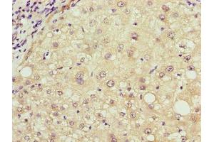 Immunohistochemistry of paraffin-embedded human liver cancer using ABIN7168042 at dilution of 1:100 (RHOJ 抗体  (AA 1-211))