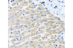 Immunohistochemistry of paraffin-embedded Human liver damage using DARS2 Polyclonal Antibody at dilution of 1:100 (40x lens). (DARS2 抗体)