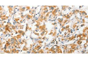 Immunohistochemistry of paraffin-embedded Human thyroid cancer tissue using ANAPC2 Polyclonal Antibody at dilution 1:30 (ANAPC2 抗体)
