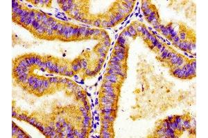 Immunohistochemistry of paraffin-embedded human endometrial cancer using ABIN7143338 at dilution of 1:100 (ADCY8 抗体  (AA 534-670))