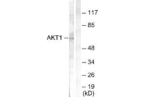 Immunohistochemistry analysis of paraffin-embedded human breast carcinoma tissue using Akt (Ab-308) antibody. (AKT1 抗体  (Thr308))