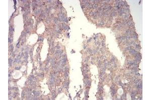 Immunohistochemical analysis of paraffin-embedded rectum cancer tissues using WNT3A mouse mAb with DAB staining.