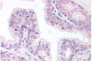 Human Prostate (formalin-fixed, paraffin-embedded) stained with ERG antibody ABIN295774 at 10 ug/ml followed by biotinylated anti-goat IgG secondary antibody ABIN481715, alkaline phosphatase-streptavidin and chromogen. (ERG 抗体  (AA 469-481))